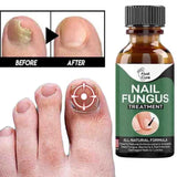 Fast Nail Fungal Treatments Nail Repair Essences Serum Care